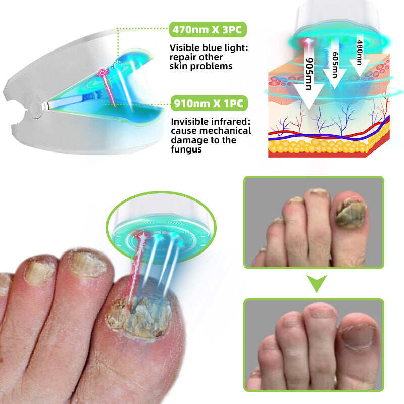 Urządzenie do laseroterapii grzybicy paznokci Furzero™ Max Plus