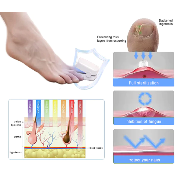 Oveallgo™ PROMAX Dispositivo revolucionário de terapia de luz de alta eficiência para doenças das unhas dos pés