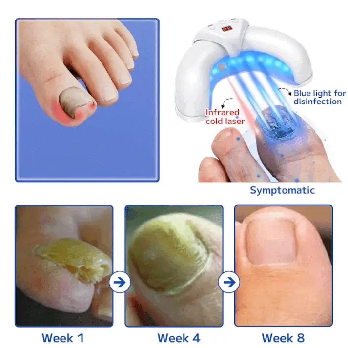 Urządzenie do laserowego leczenia grzybicy paznokci Fuzero™