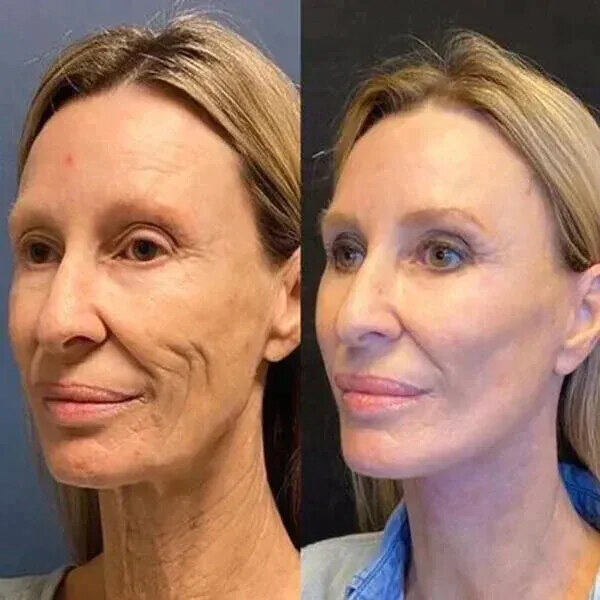 ✨Promoção de último dia 70% OFF✨ - Botox Facial Luxo - Essência