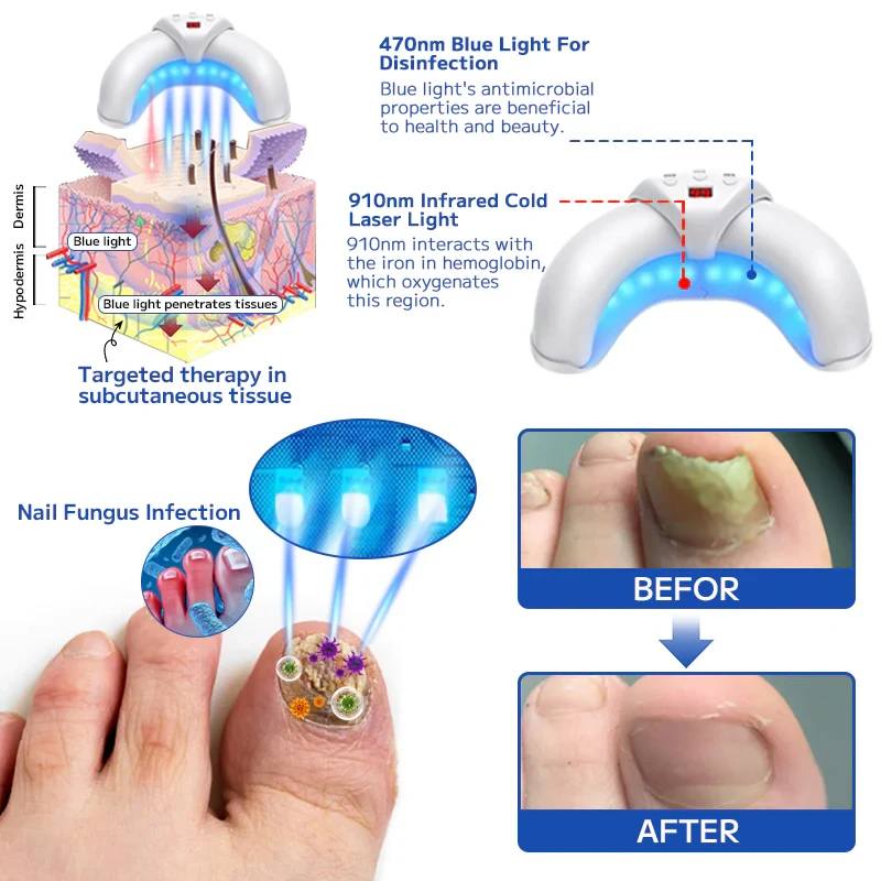 Urządzenie do laserowego leczenia grzybicy paznokci Fuzero™